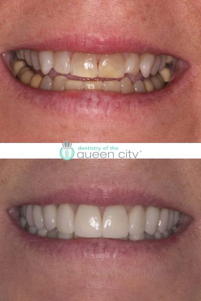 Before and after dental services at Coastal Cosmetic & Implant Dentistry