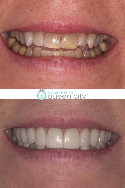 Before and after dental services at Dentistry of the Queen City