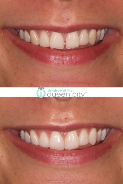 Before and after dental services at Coastal Cosmetic & Implant Dentistry