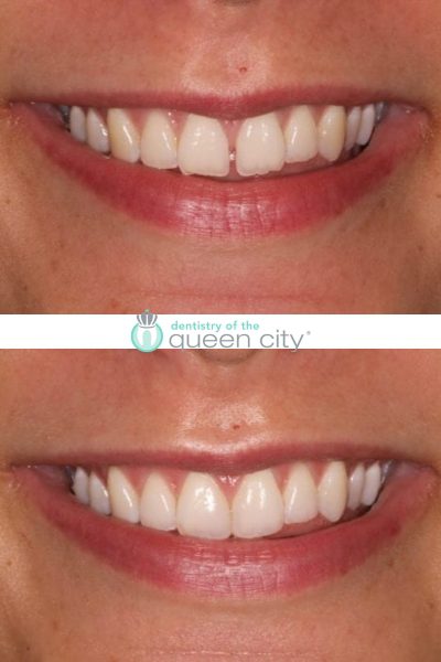 Before and after dental services at Dentistry of the Queen City