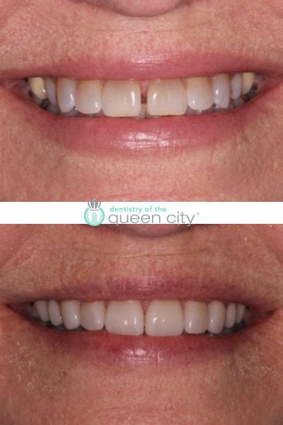 Before and after dental services at Coastal Cosmetic & Implant Dentistry