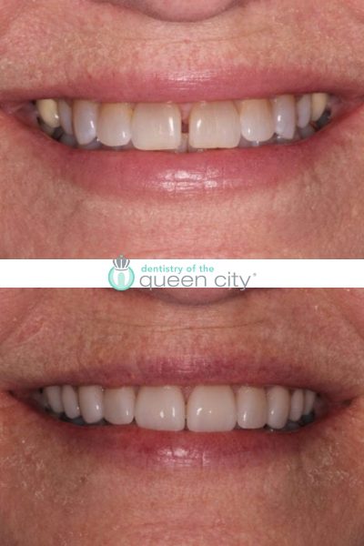 Before and after dental services at Dentistry of the Queen City