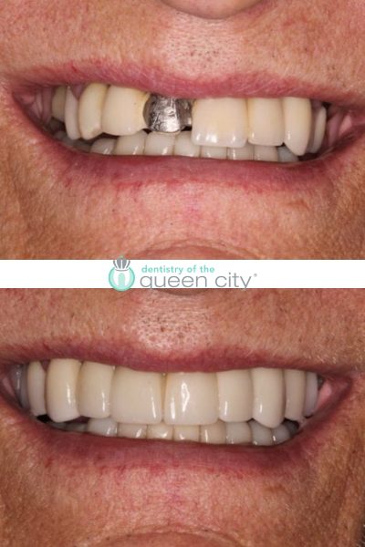 Before and after dental services at Coastal Cosmetic & Implant Dentistry