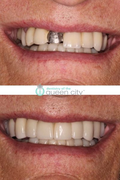 Before and after dental services at Dentistry of the Queen City