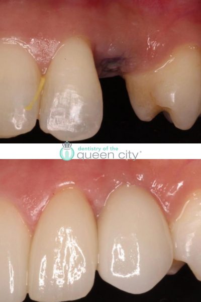 Before and after dental services at Coastal Cosmetic & Implant Dentistry