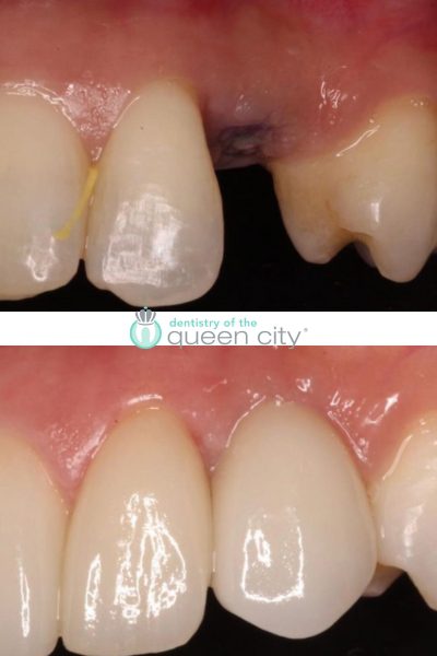 Before and after dental services at Dentistry of the Queen City