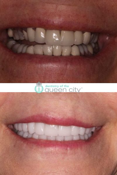 Before and after dental services at Coastal Cosmetic & Implant Dentistry
