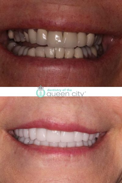 Before and after dental services at Dentistry of the Queen City