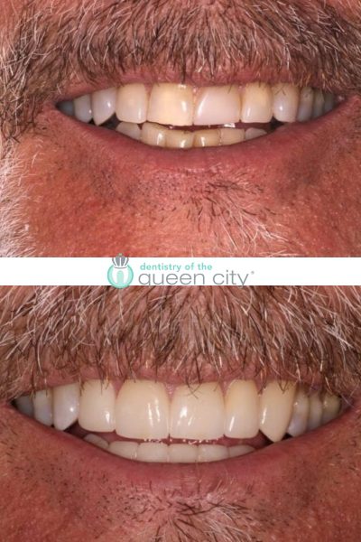 Before and after dental services at Coastal Cosmetic & Implant Dentistry