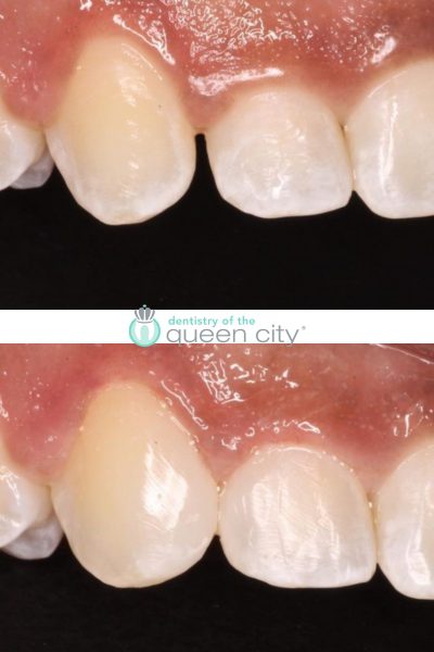 Before and after dental services at Dentistry of the Queen City