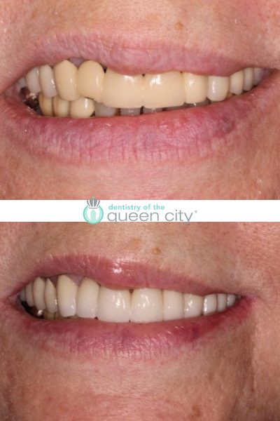 Before and after dental services at Dentistry of the Queen City