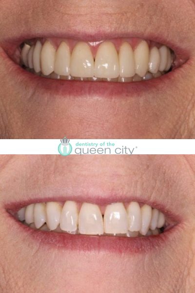 Before and after dental services at Dentistry of the Queen City