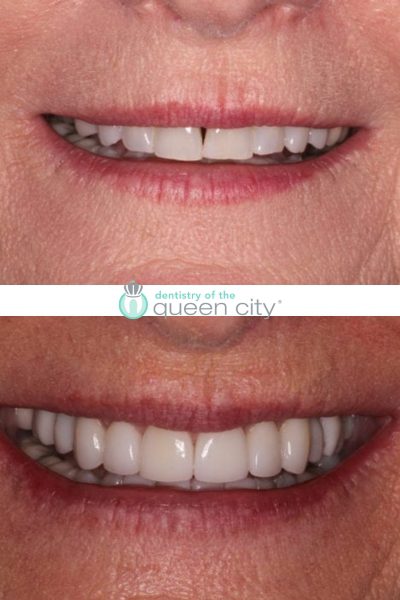 Before and after dental services at Coastal Cosmetic & Implant Dentistry
