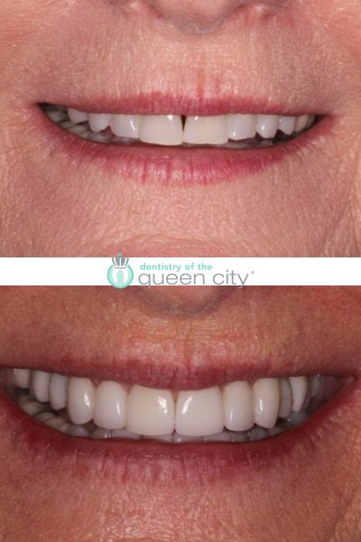 Before and after dental services at Dentistry of the Queen City