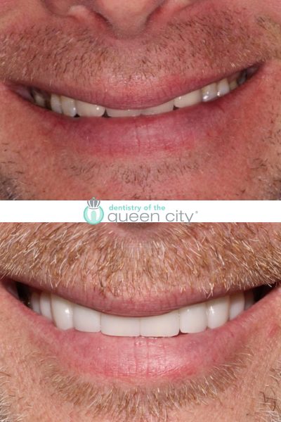 Before and after dental services at Coastal Cosmetic & Implant Dentistry