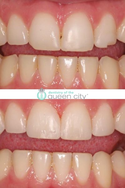 Before and after dental services at Dentistry of the Queen City