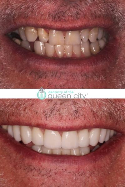 Before and after dental services at Coastal Cosmetic & Implant Dentistry