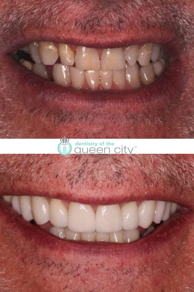 Before and after dental services at Dentistry of the Queen City