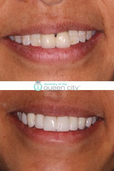 Before and after dental services at Dentistry of the Queen City