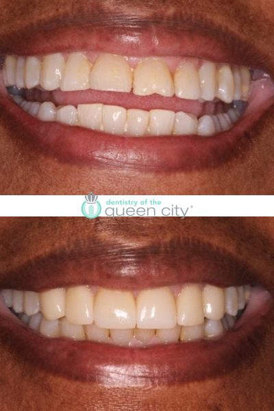 Before and after dental services at Coastal Cosmetic & Implant Dentistry