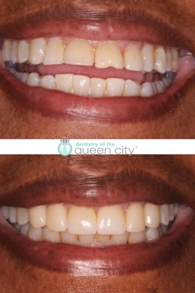 Before and after dental services at Dentistry of the Queen City