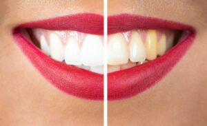 How to Remove Your Tooth Stains