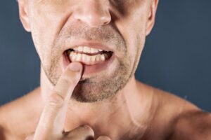 Don't Ignore Teeth Grinding Habits, Dentistry of the queen city