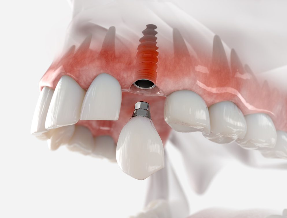 In the realm of dentistry, few conditions affect oral health and personal confidence as gravely as missing teeth.