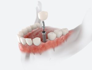 Understanding the process for getting dental implants could help alleviate fears and concerns so you can get the treatment you need.