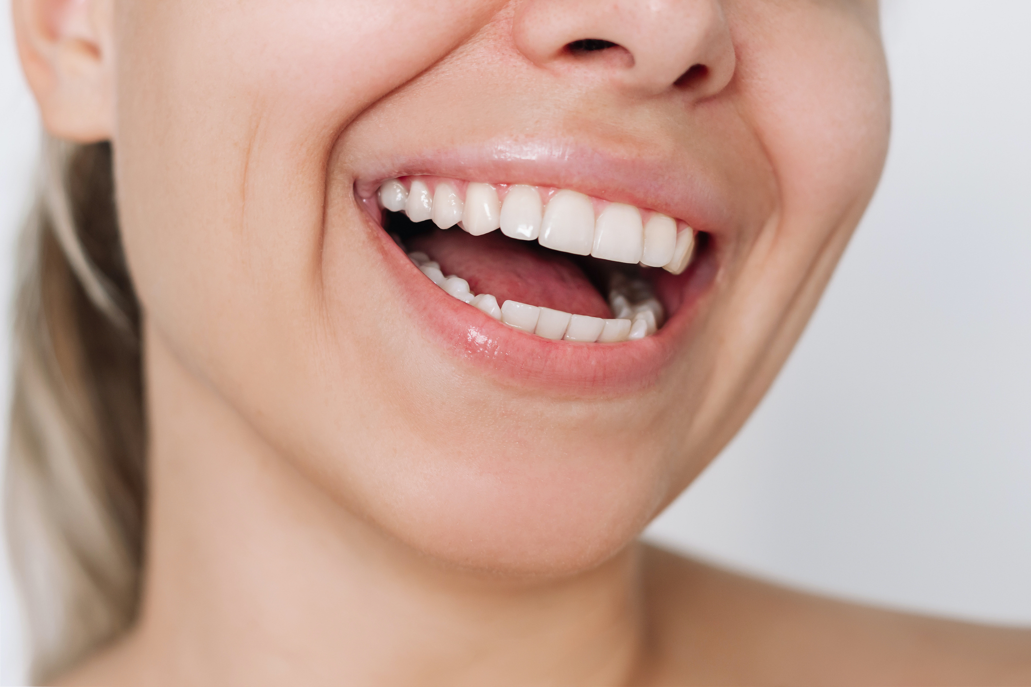Teeth Whitening available at Charlotte, NC