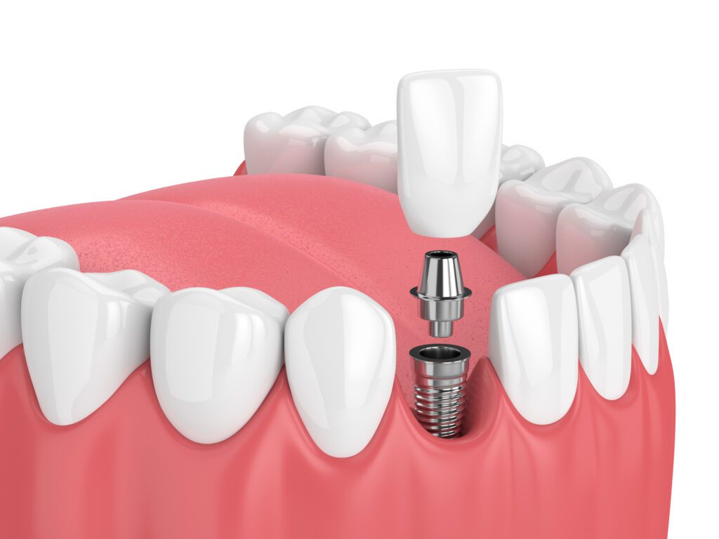 Dental Implants in Charlotte NC