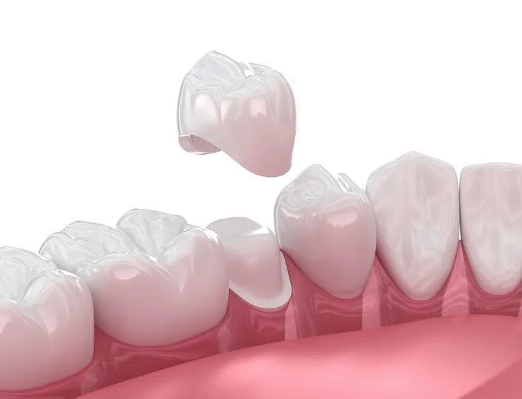 Aftercare for a Dental Crown in Charlotte, NC