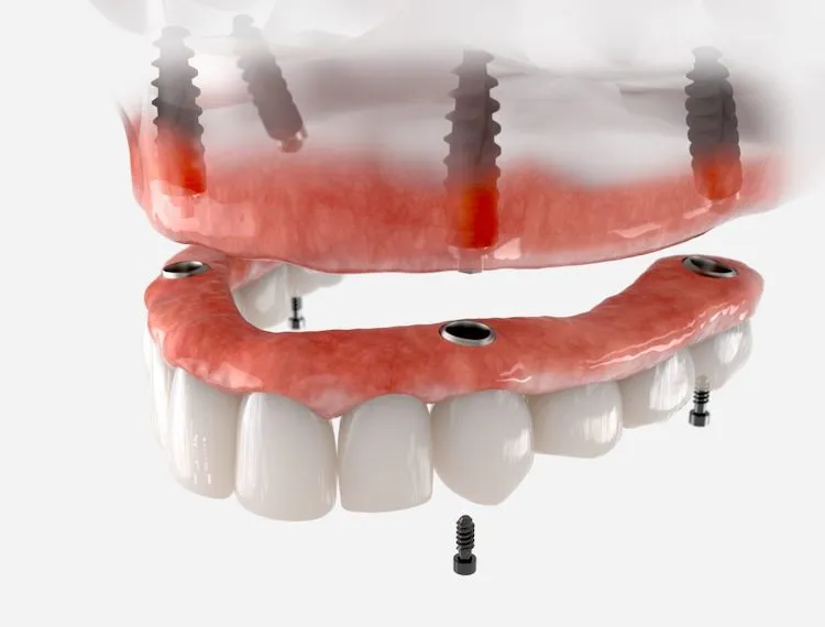Can Dentures Be Comfortable? in Charlotte, NC