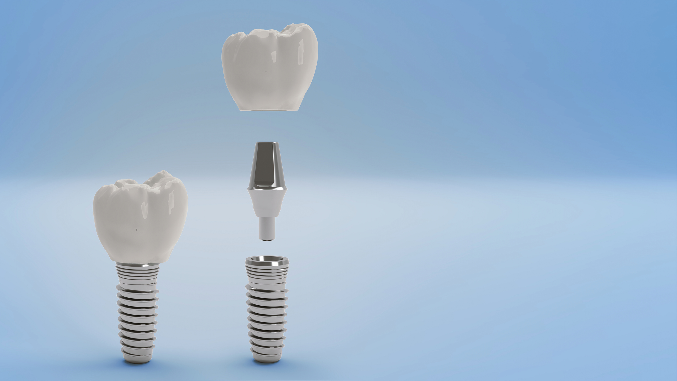 Dental Implant Parts Charlotte NC