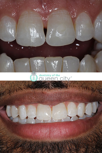 Dental patient before and after image in charlotte, NC